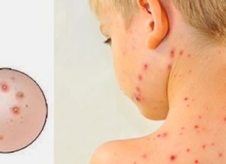Agar Virus Campak Tak Mewabah, Sosialisasi Sejak Dini
