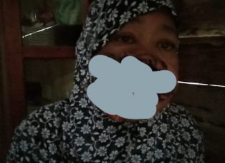 Kisah Salmia Penderita Tumor Ganas di Mateng